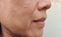 Dull complexion