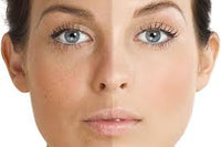 Uneven skin tone